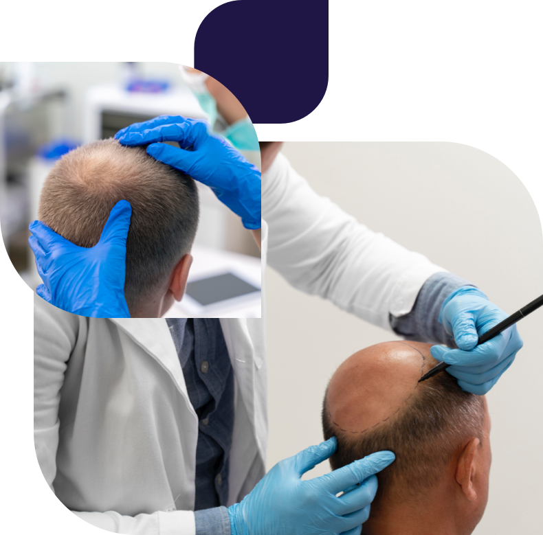 عملية زراعة الشعر