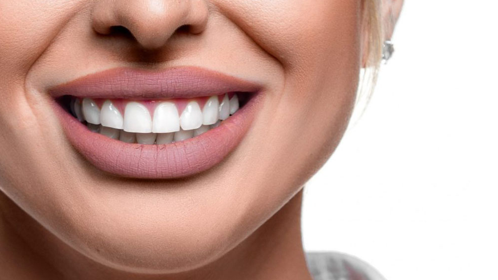 الفرق بين تبييض الاسنان وابتسامة هوليود 6 الفرق بين ابتسامة هوليود وتبييض الأسنان