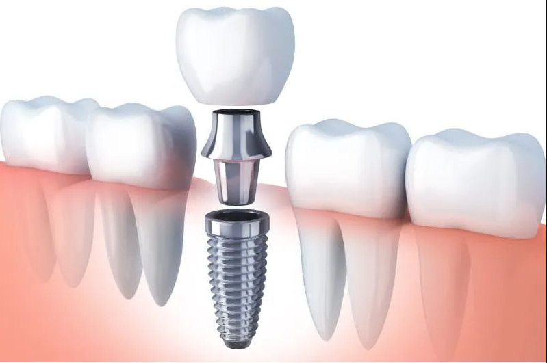 دليل زراعة الأسنان: الأسعار ومميزات كل نوع لاختيار الأنسب لك 6 انواع زراعة الأسنان واسعارها