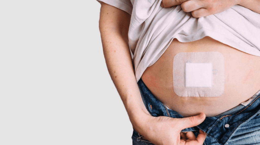 حدوث فتق في وسط البطن