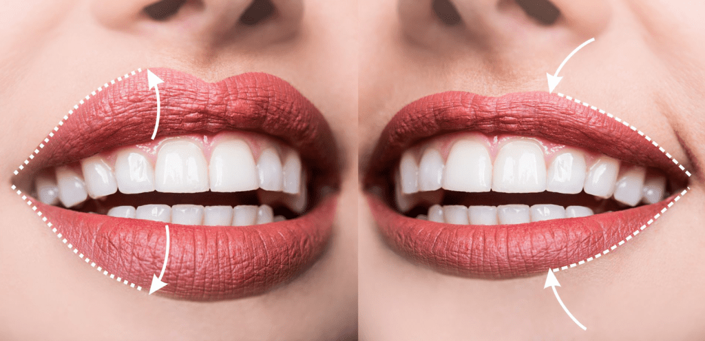 كنتور الشفايف