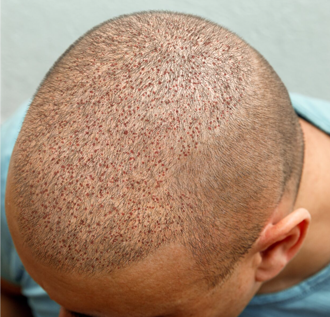 بعد عملية زراعة الشعر