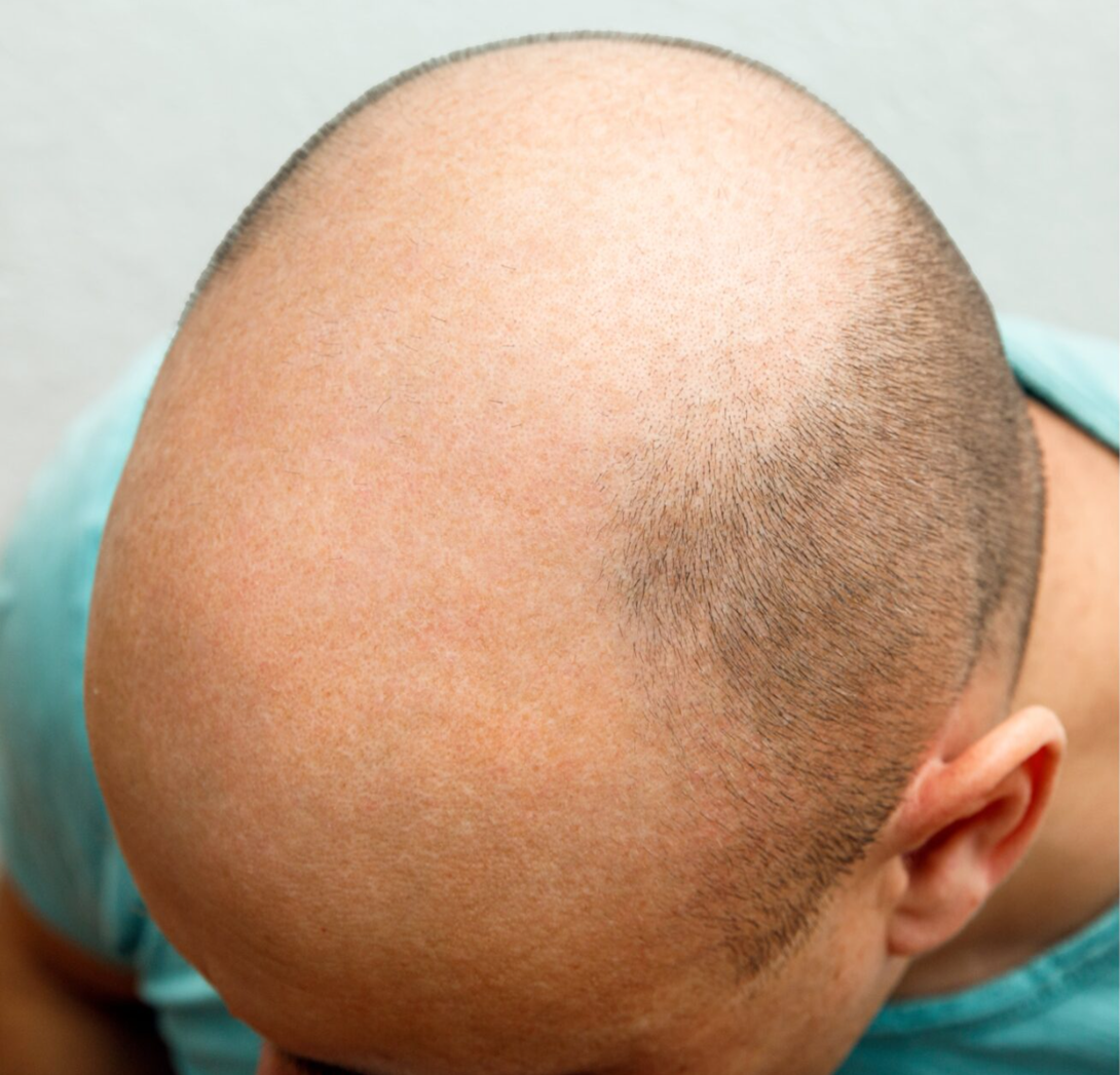 hair-transplant-before قبل عملية زراعة الشعر