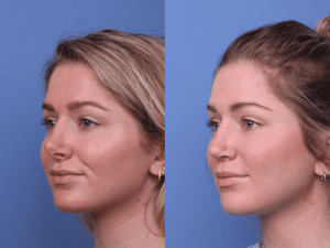 قبل وبعد عملية تجميل الأنف