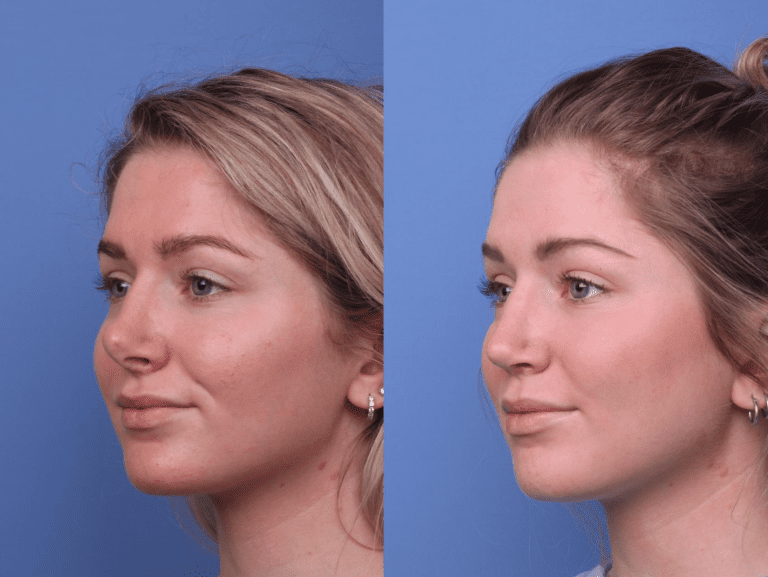 قبل وبعد عملية تجميل الأنف