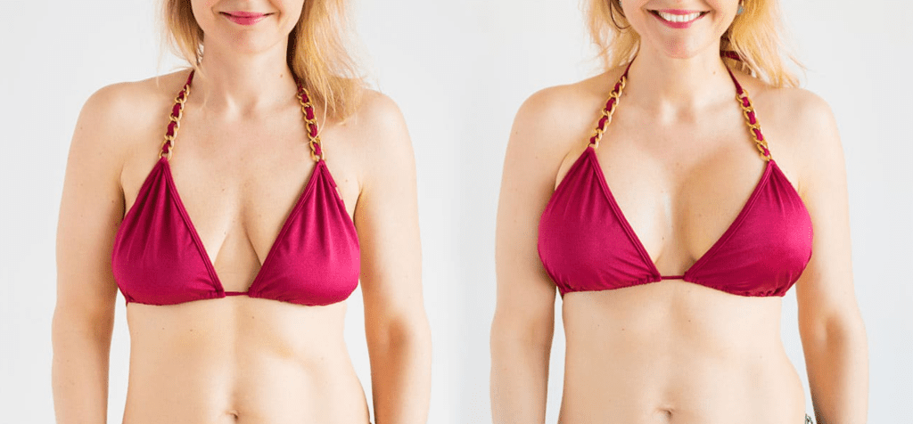 جراحة تكبير الصدر - أهم 20 سؤال شائع والاجابة عليهم 22 نتائج عملية تكبير الصدر قبل وبعد