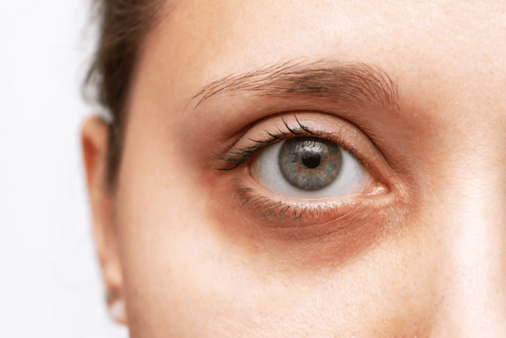 علاج الهالات السوداء تحت العين