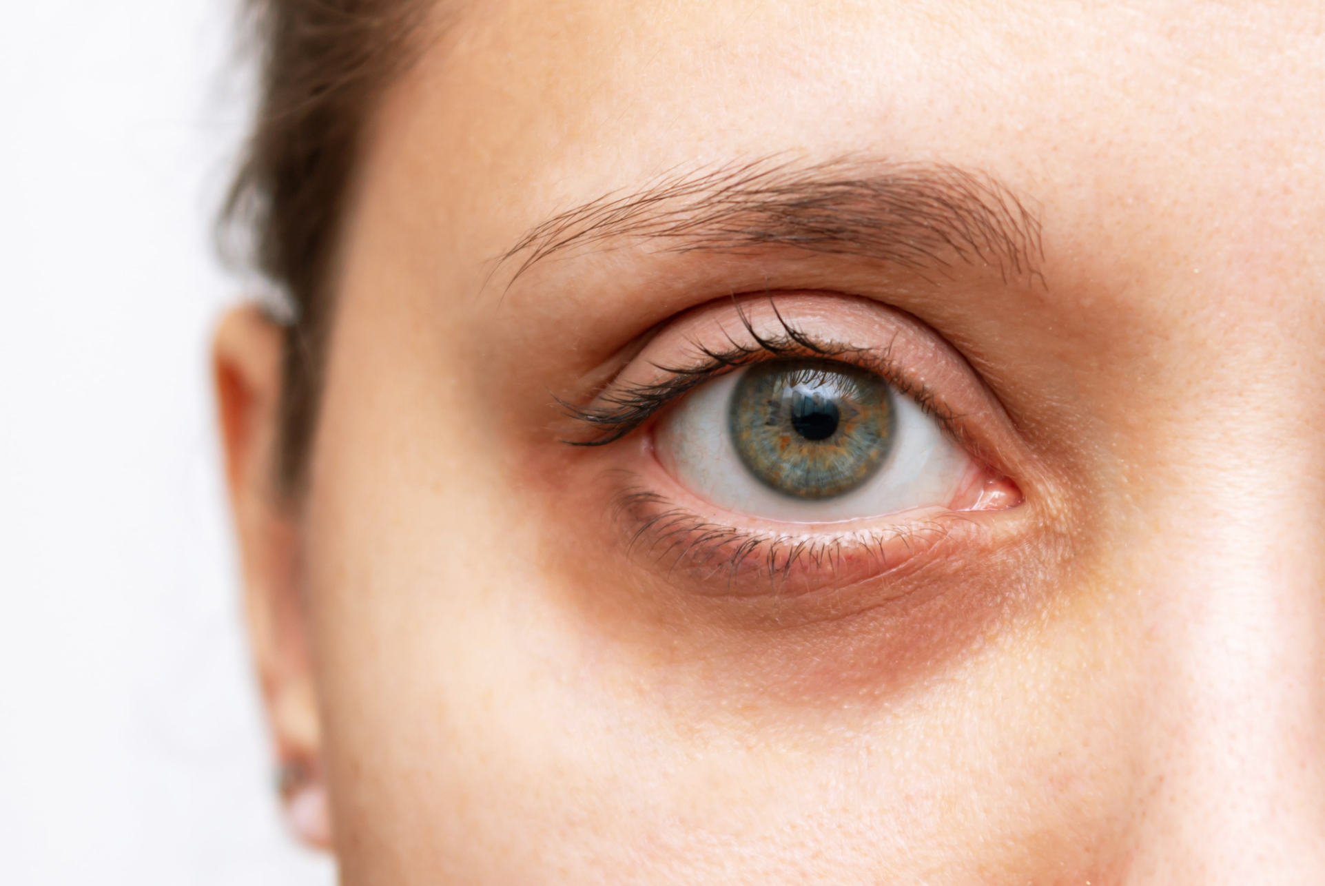 طب العيون 13 علاج الهالات السوداء تحت العين