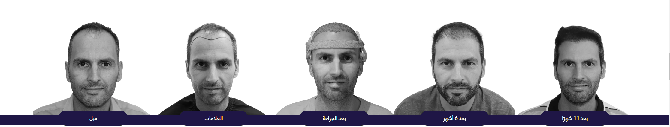 مراحل نمو و نتائج زراعة الشعر خلال سنة