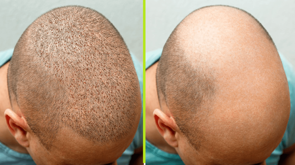 نتائج زراعة الشعر في السعودية قبل وبعد