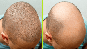 نتائج زراعة الشعر في السعودية قبل وبعد