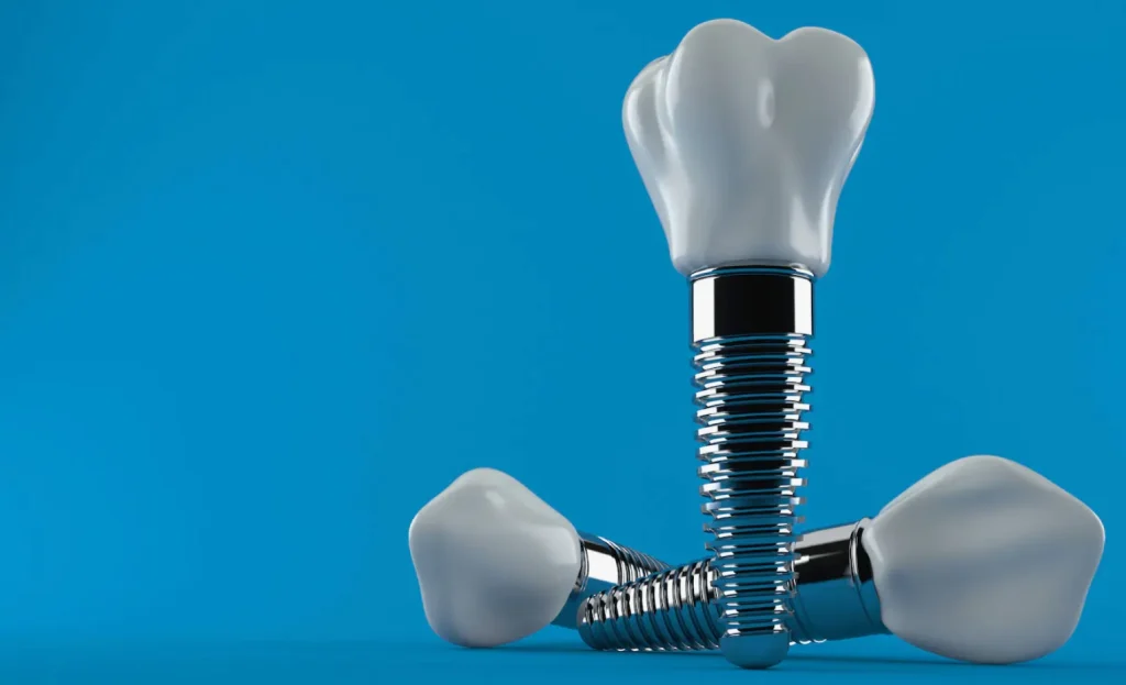 أنواع زراعة الأسنان وأسعارها في السعودية 17 أنواع زراعة الأسنان