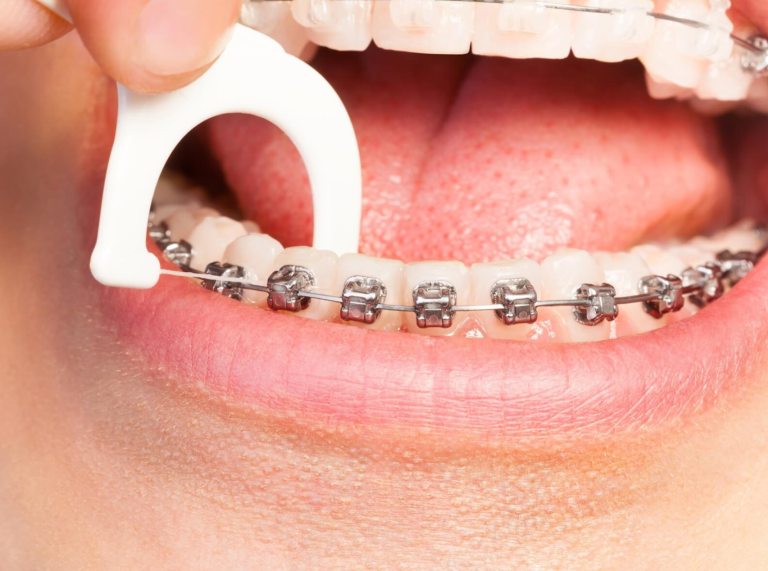 تجميل الأسنان والتقويم