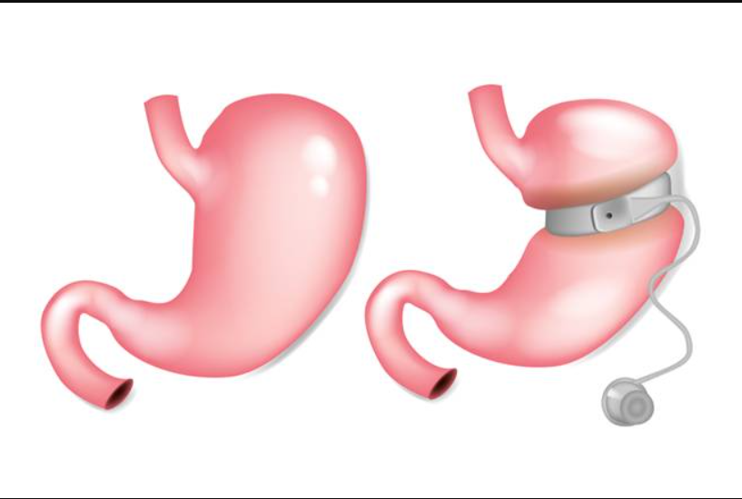 عملية تكميم المعدة؛ أثارها وفوائدها ومخاطرها وكل ما تريد معرفته حولها 9 تحاليل الدم الشاملة | 7 فحوص أساسية تشرح صحتك