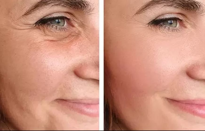 عملية شد الوجه مراحلها وأنواعها وكل ما تحتاج معرفته حولها 10 عملية شد الوجه