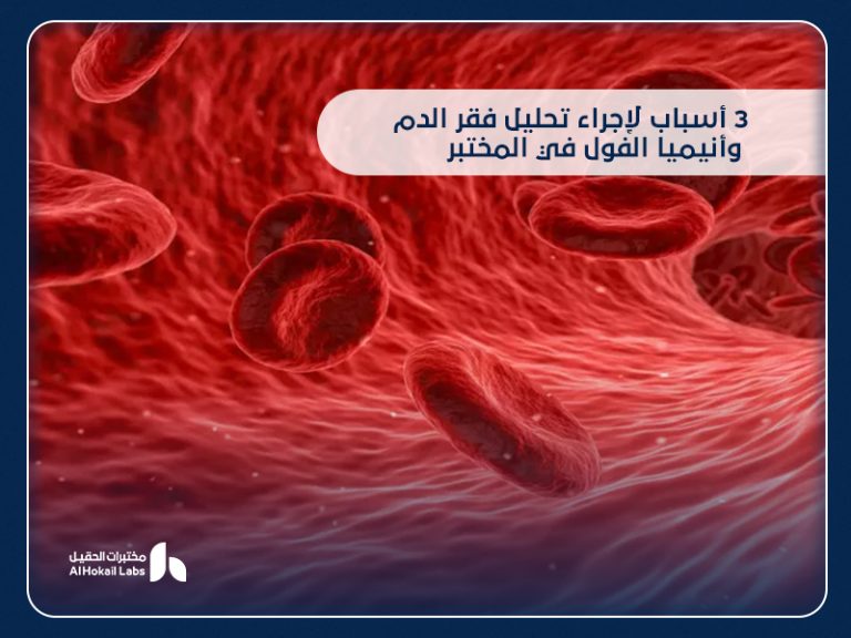 فقر الدم وأنيميا الفول: الأسباب، الأعراض، وطرق التشخيص من مختبرات الحقيل
