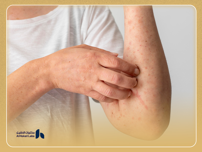 ما هي خطوات إجراء فحص الحساسية الغذائية؟